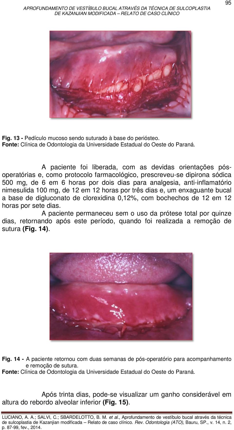 anti-inflamatório nimesulida 100 mg, de 12 em 12 horas por três dias e, um enxaguante bucal a base de digluconato de clorexidina 0,12%, com bochechos de 12 em 12 horas por sete dias.