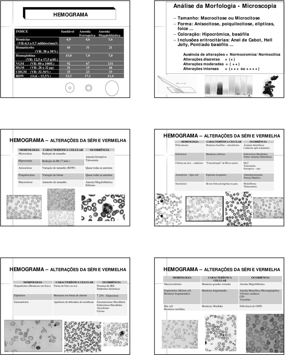 Anisocitose, poiquilocitose, elipticas, foice... Coloração: Hipocrômica, basófila Inclusões eritrocitárias: Anel de Cabot, Hell Jolly, Pontiado basófilo.