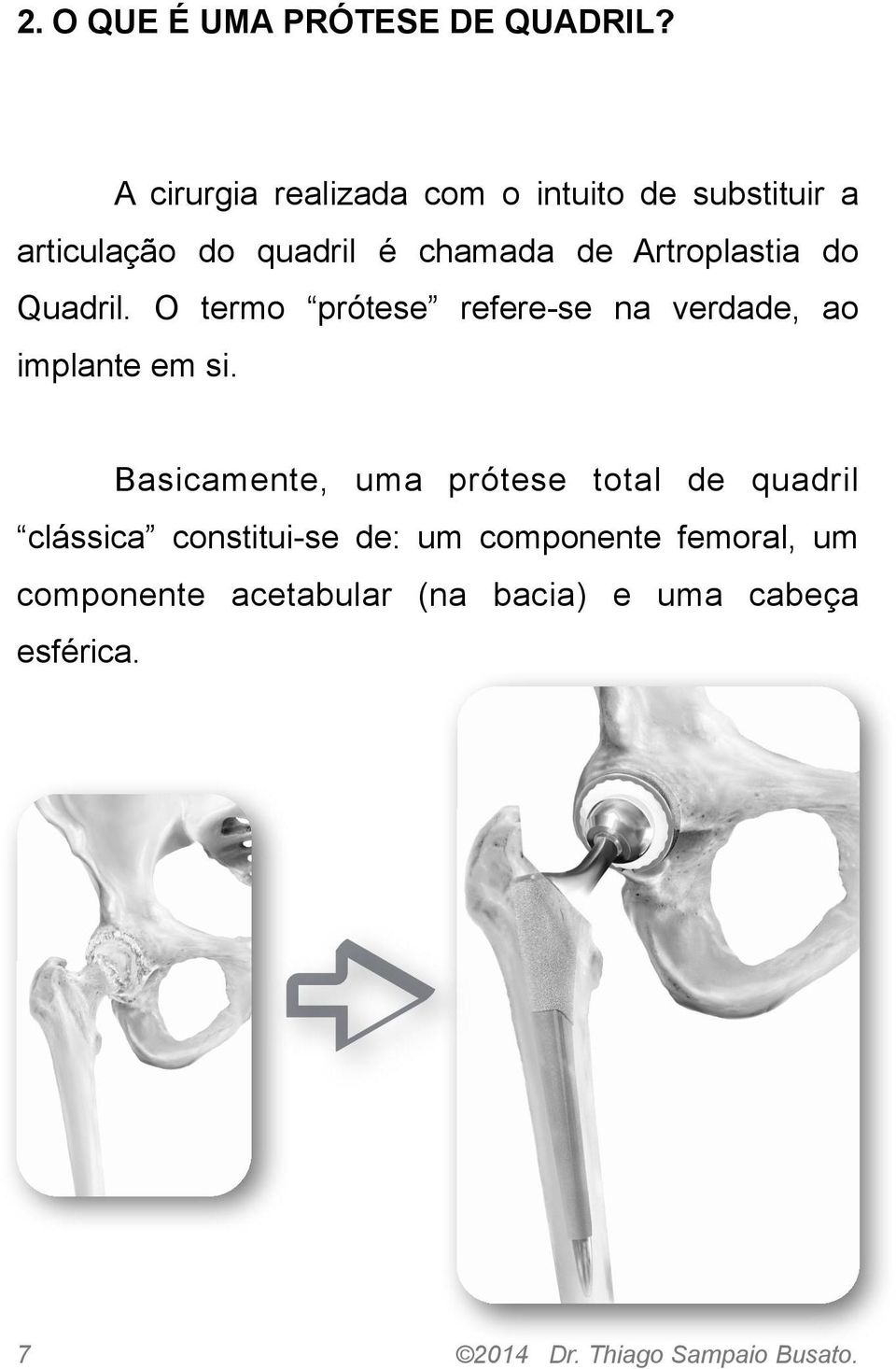 Artroplastia do Quadril. O termo prótese refere-se na verdade, ao implante em si.
