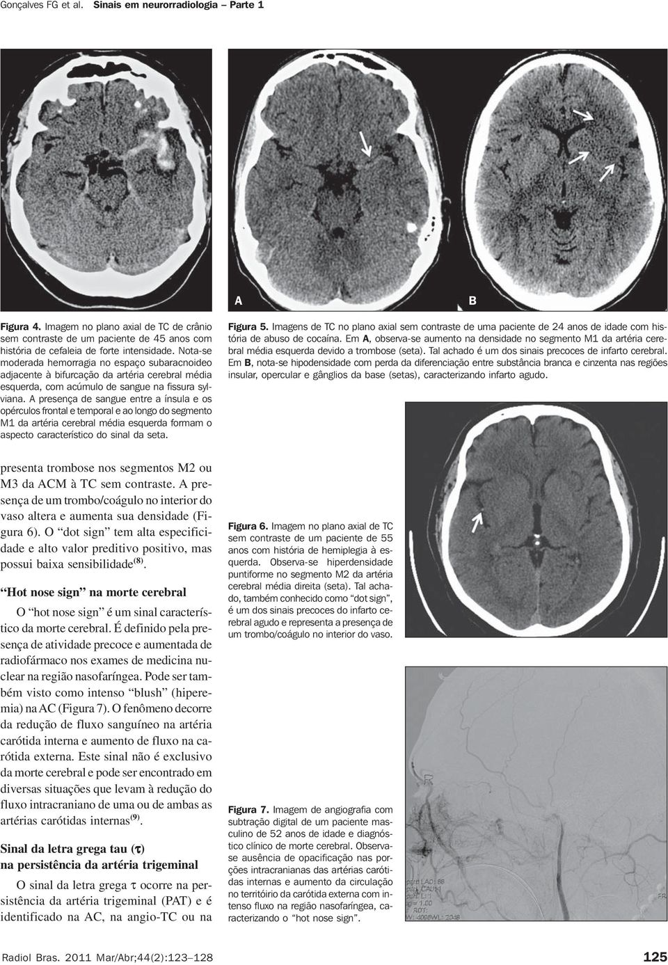 presença de sangue entre a ínsula e os opérculos frontal e temporal e ao longo do segmento M1 da artéria cerebral média esquerda formam o aspecto característico do sinal da seta. Figura 5.