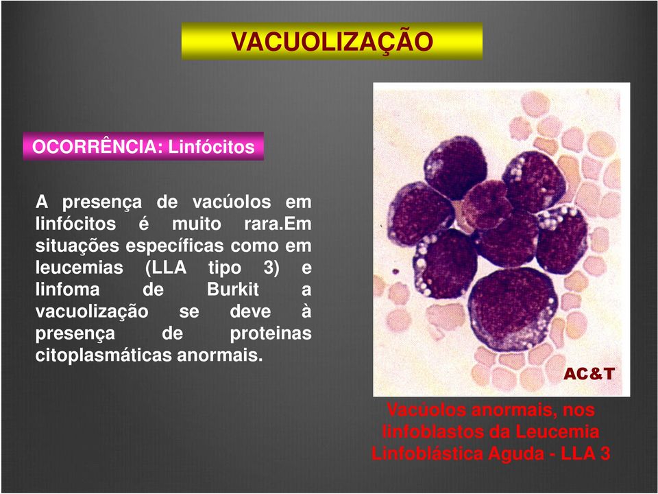 em situações específicas como em leucemias (LLA tipo 3) e linfoma de Burkit a