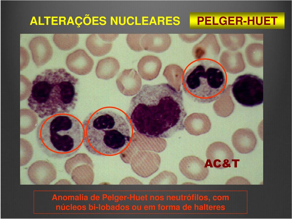 Pelger-Huet nos neutrófilos,