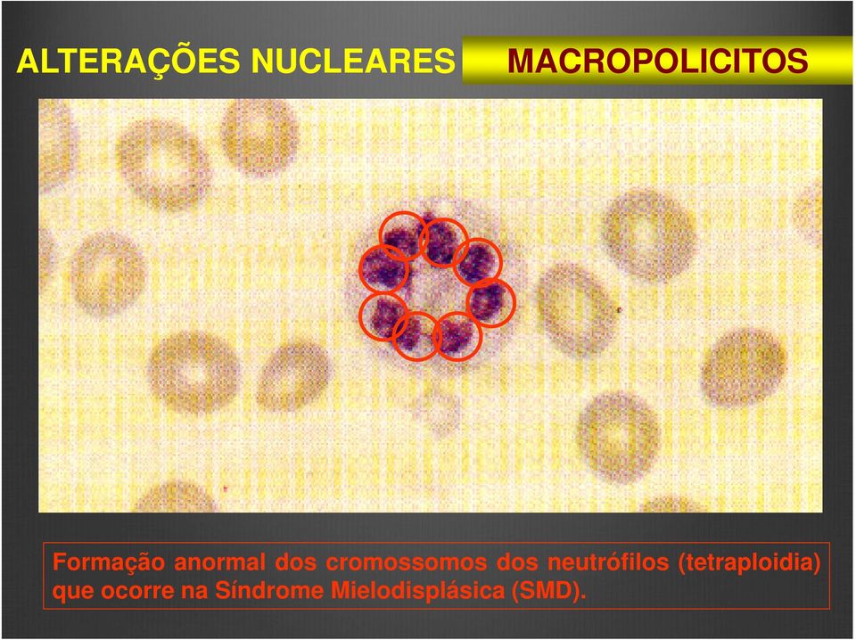 neutrófilos (tetraploidia) que