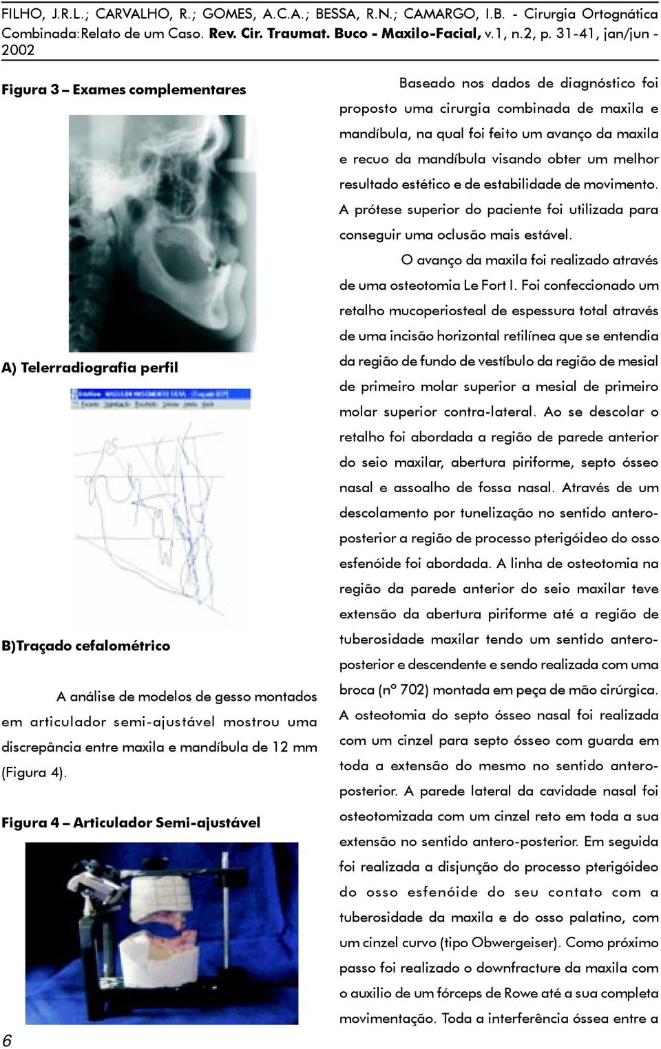 Figura 4 Articulador Semi-ajustável 6 Baseado nos dados de diagnóstico foi proposto uma cirurgia combinada de maxila e mandíbula, na qual foi feito um avanço da maxila e recuo da mandíbula visando