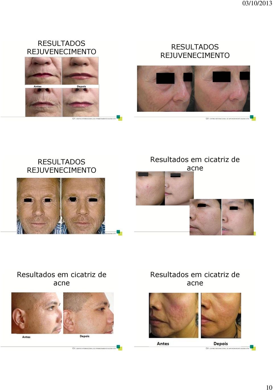 Resultados em cicatriz de acne Resultados