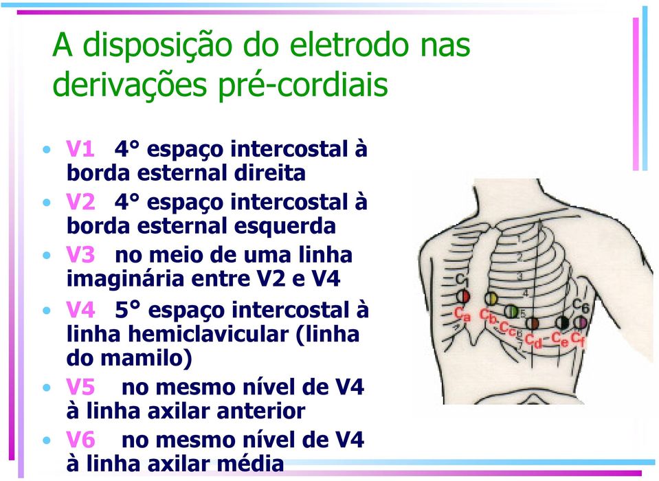 linha imaginária entre V2 e V4 V4 5 espaço intercostal à linha hemiclavicular (linha do