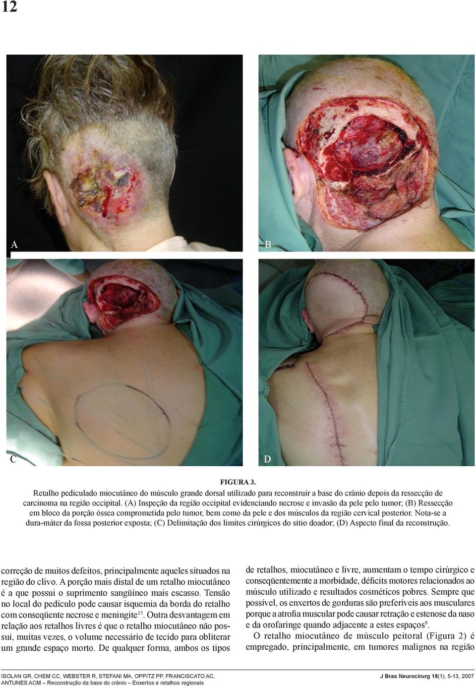 posterior. Nota-se a dura-máter da fossa posterior exposta; (C) Delimitação dos limites cirúrgicos do sítio doador; (D) Aspecto final da reconstrução.