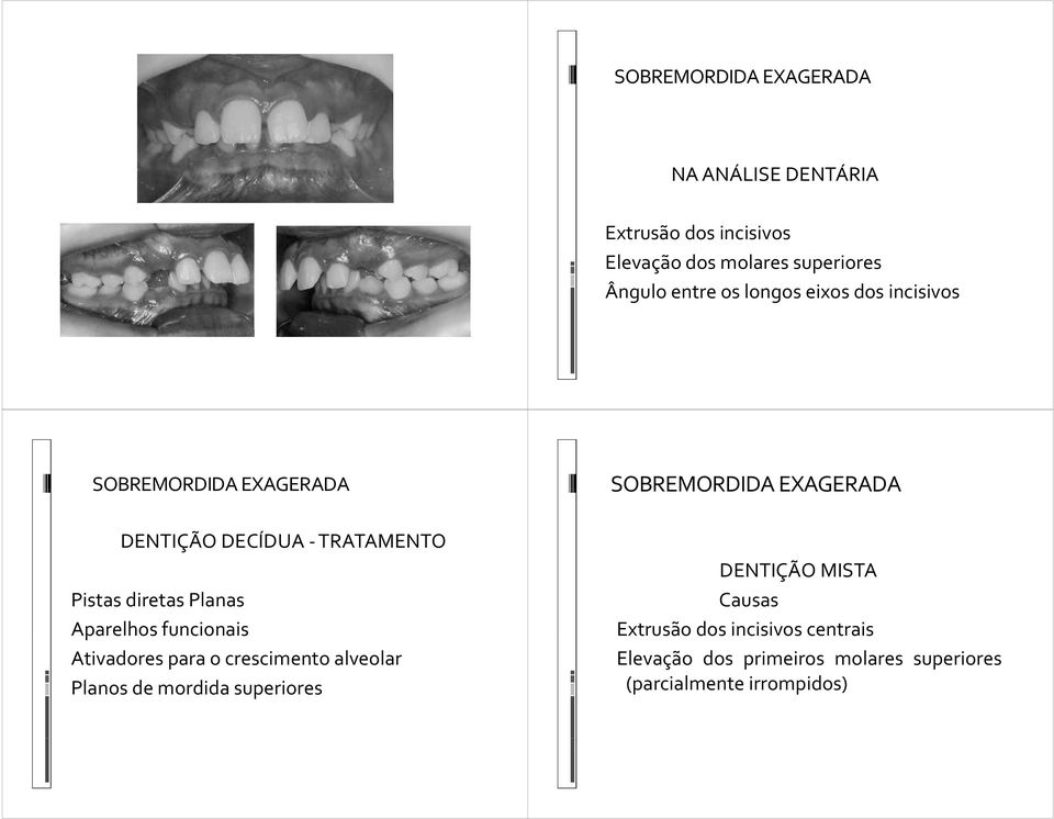 diretas Planas Aparelhos funcionais Ativadores para o crescimento alveolar Planos de mordida superiores