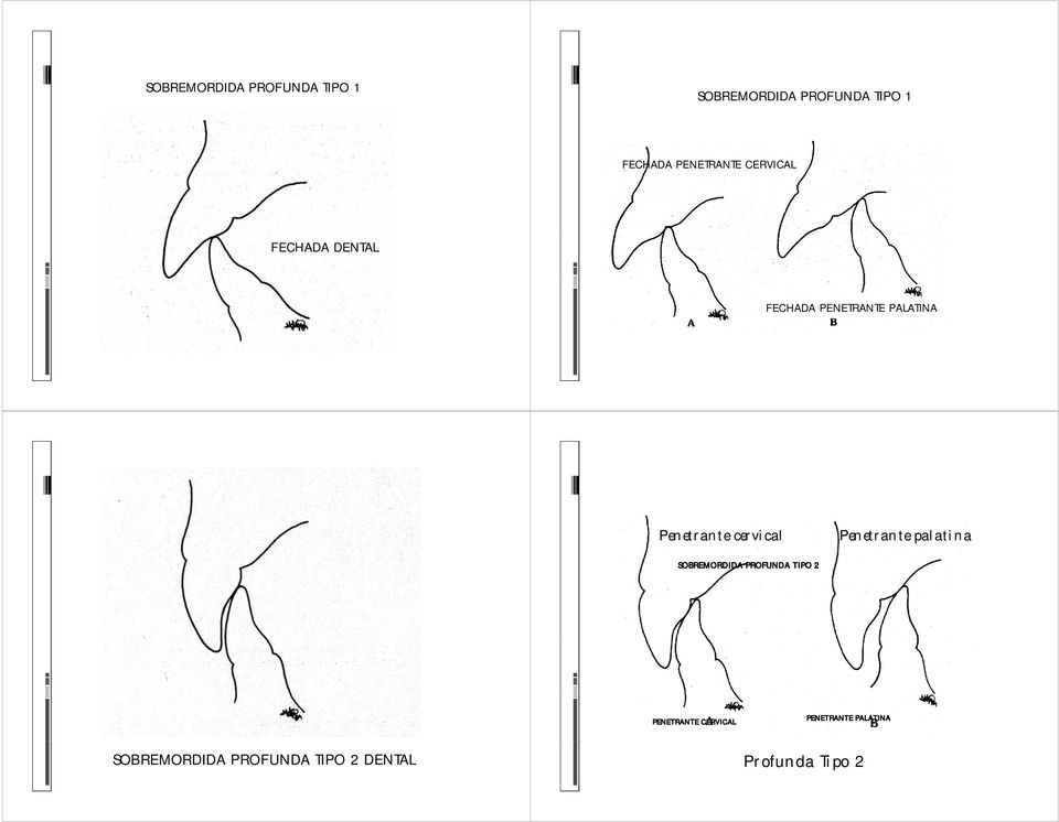 Penetrante cervical Penetrante palatina SOBREMORDIDA PROFUNDA TIPO 2