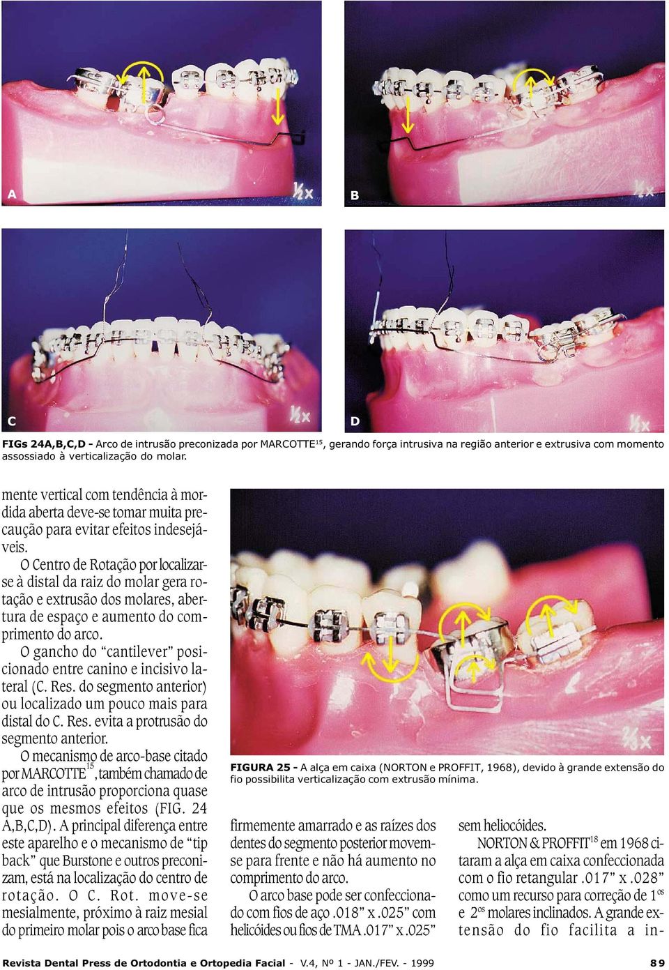 O gancho do cantilever posicionado entre canino e incisivo lateral (C. Res. do segmento anterior) ou localizado um pouco mais para distal do C. Res. evita a protrusão do segmento anterior.