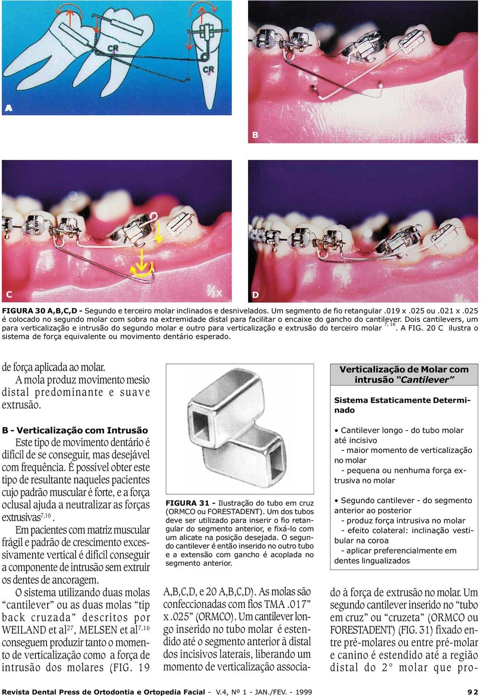 Em pacientes com matriz muscular frágil e padrão de crescimento excessivamente vertical é difícil conseguir a componente de intrusão sem extruir os dentes de ancoragem.