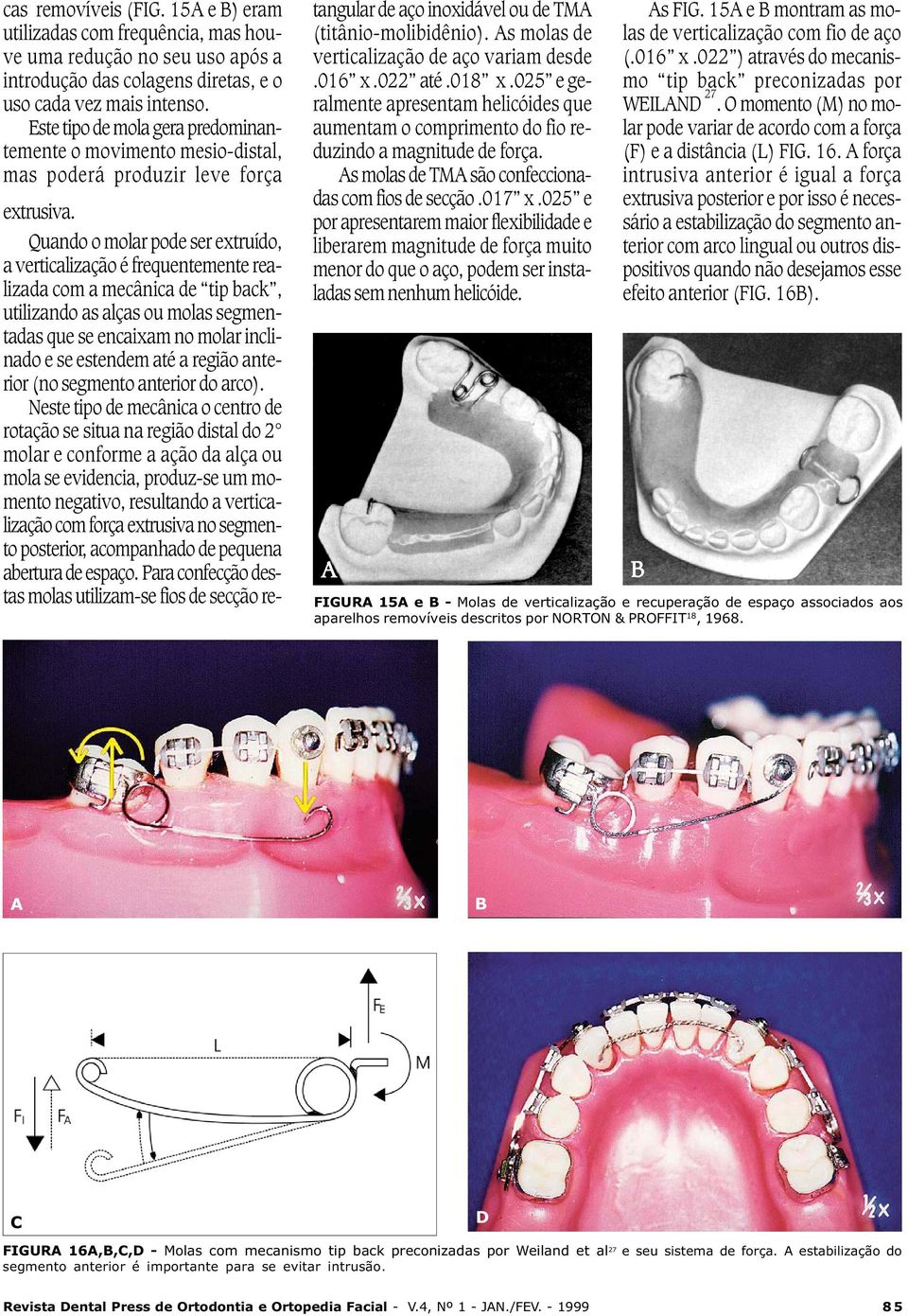 Quando o molar pode ser extruído, a verticalização é frequentemente realizada com a mecânica de tip back, utilizando as alças ou molas segmentadas que se encaixam no molar inclinado e se estendem até