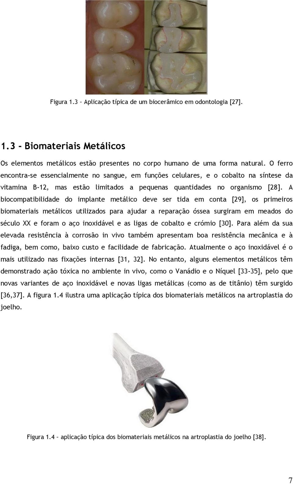 A biocompatibilidade do implante metálico deve ser tida em conta [29], os primeiros biomateriais metálicos utilizados para ajudar a reparação óssea surgiram em meados do século XX e foram o aço