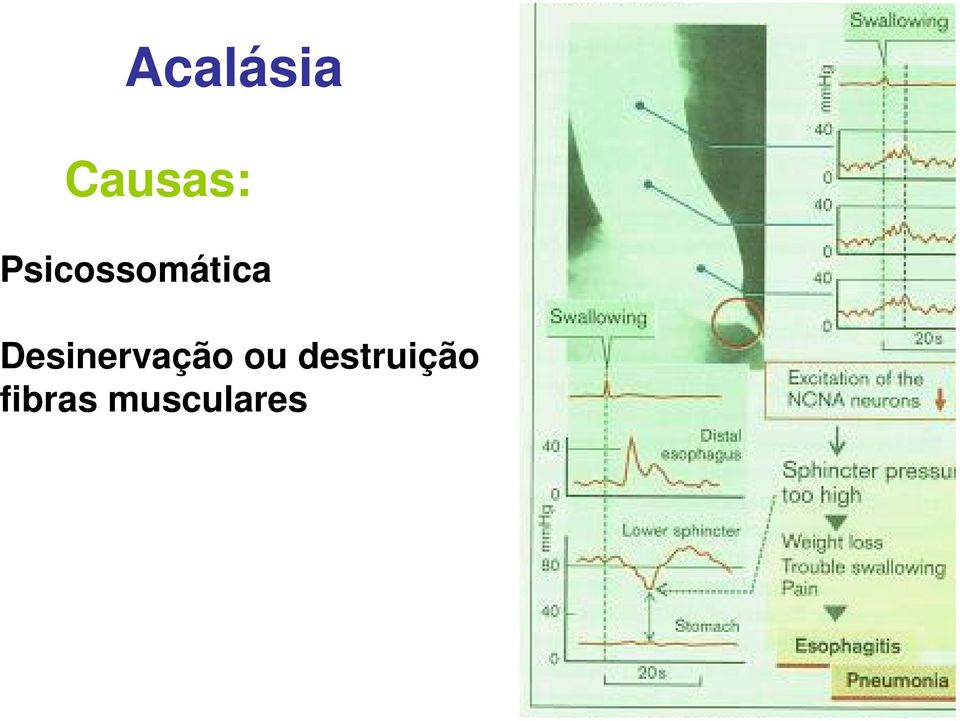 Desinervação ou