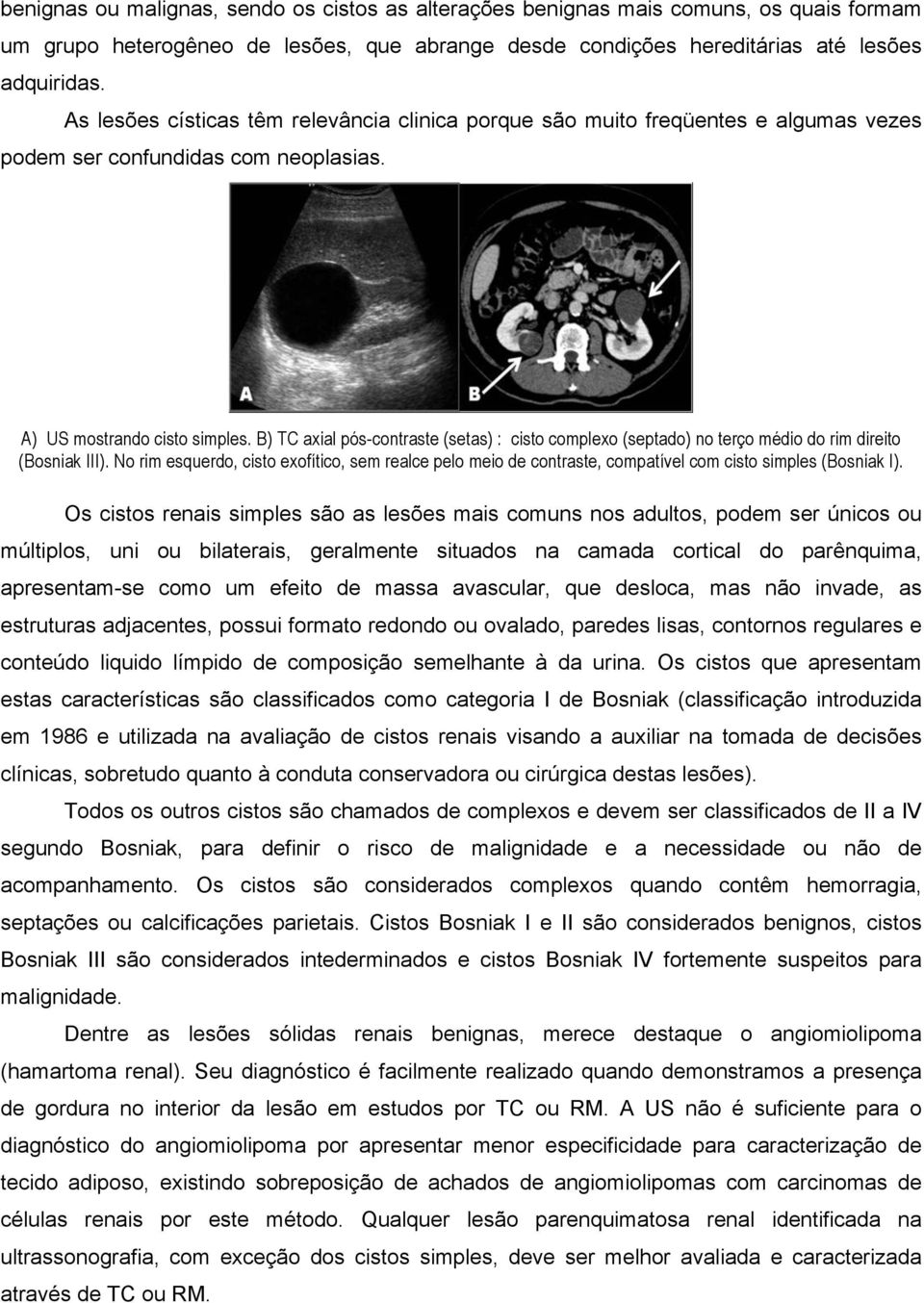 B) TC axial pós-contraste (setas) : cisto complexo (septado) no terço médio do rim direito (Bosniak III).