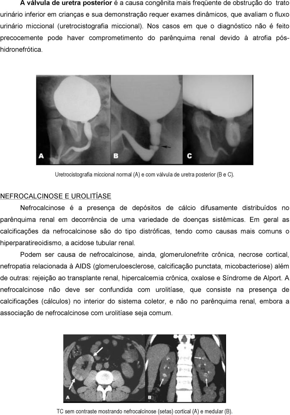 Uretrocistografia miccional normal (A) e com válvula de uretra posterior (B e C).