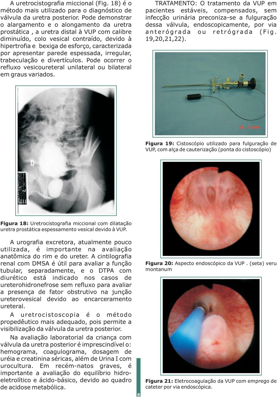 apresentar parede espessada, irregular, trabeculação e divertículos. Pode ocorrer o refluxo vesicoureteral unilateral ou bilateral em graus variados.