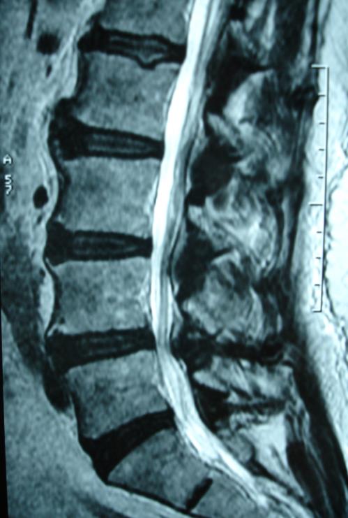 DD altura discal Colapso do ligamento amarelo Frouxidão ligamentar Sobrecarga articulações interapofisárias Remodelação