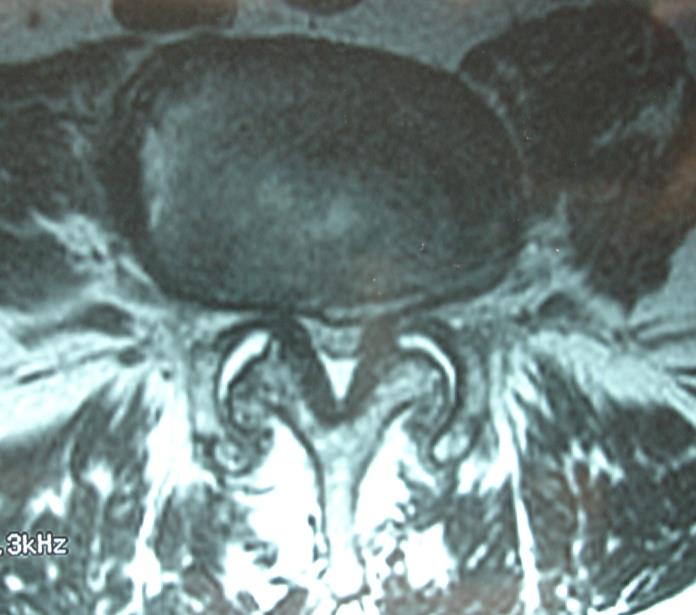 DD altura discal Colapso do ligamento amarelo Frouxidão ligamentar Sobrecarga articulações interapofisárias Remodelação