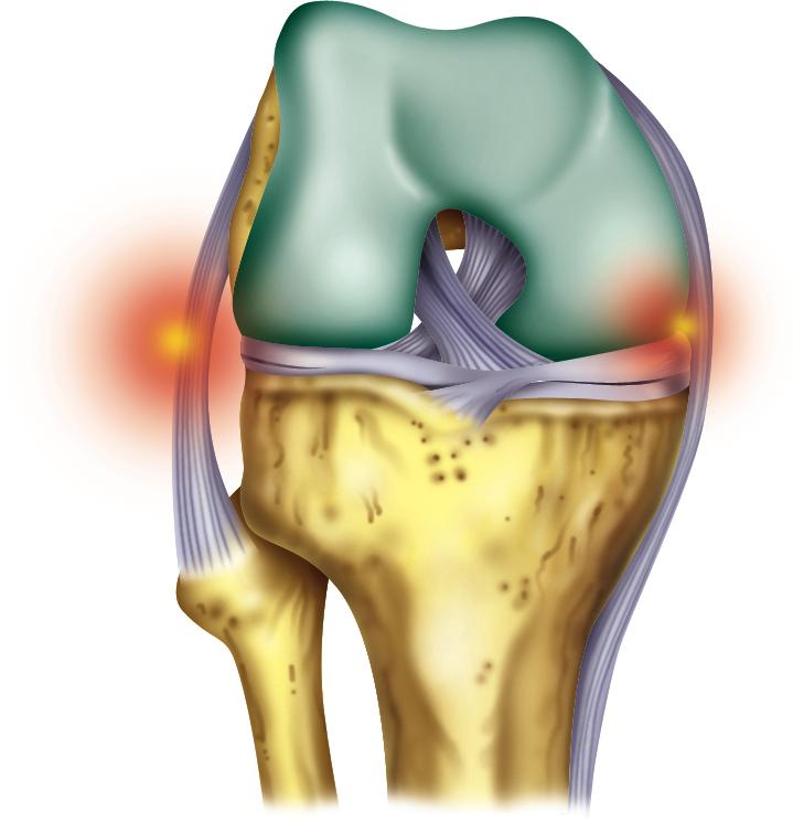 OSTEOARTROSE DEFINIÇÃO-TOPOGRAFIA-CLASSIFICAÇÃO OSTEOARTROSE