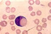 Monócitos Morfologia na doença Núcleo oval a arredondado Citoplasma abundante Vacúolos proeminentes,
