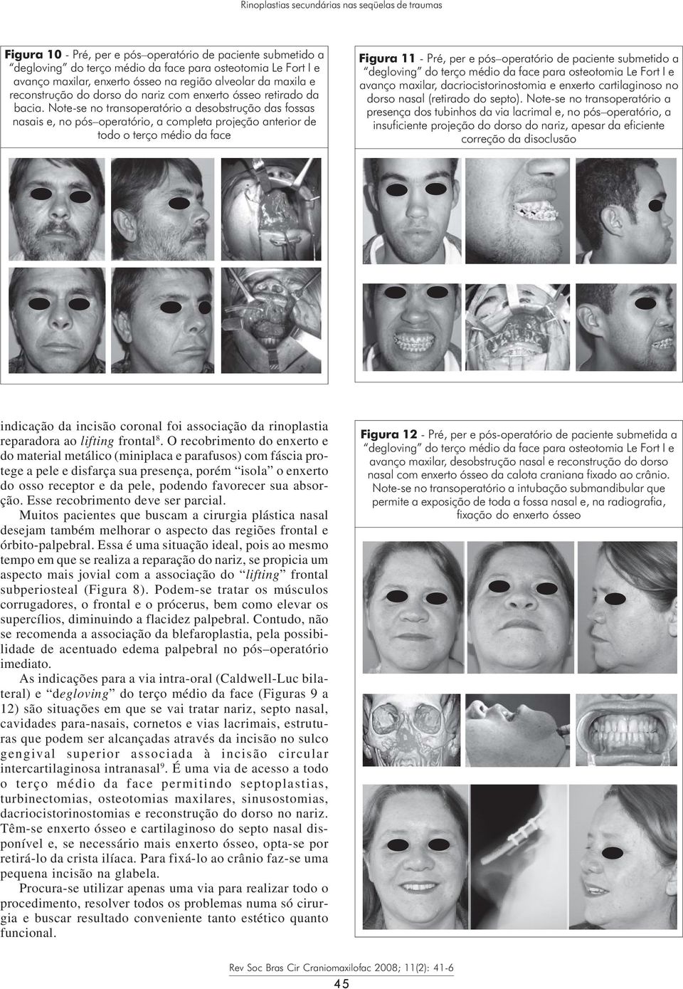 Note-se no transoperatório a desobstrução das fossas nasais e, no pós operatório, a completa projeção anterior de todo o terço médio da face Figura 11 - Pré, per e pós operatório de paciente