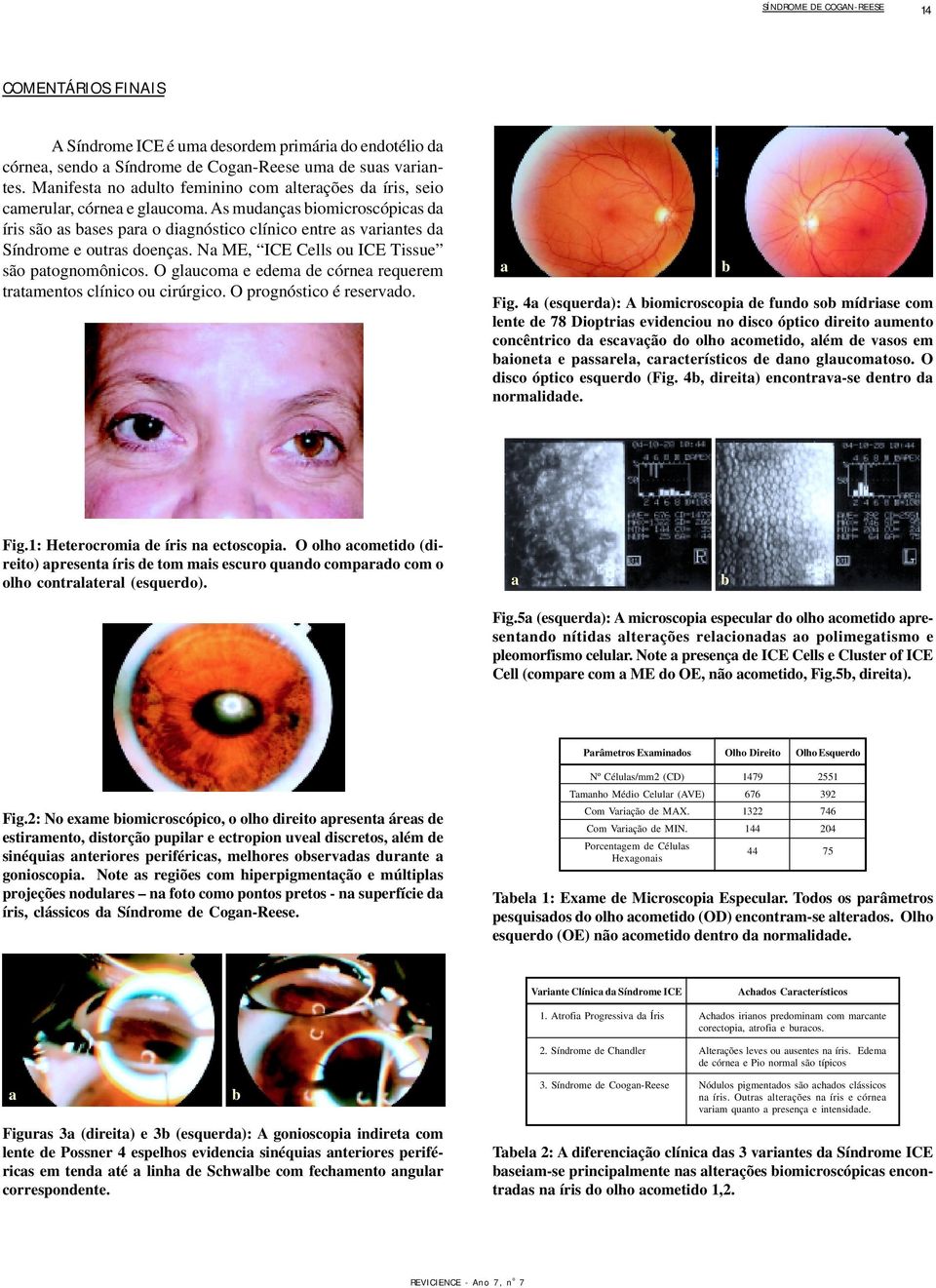 As mudanças biomicroscópicas da íris são as bases para o diagnóstico clínico entre as variantes da Síndrome e outras doenças. Na ME, ICE Cells ou ICE Tissue são patognomônicos.