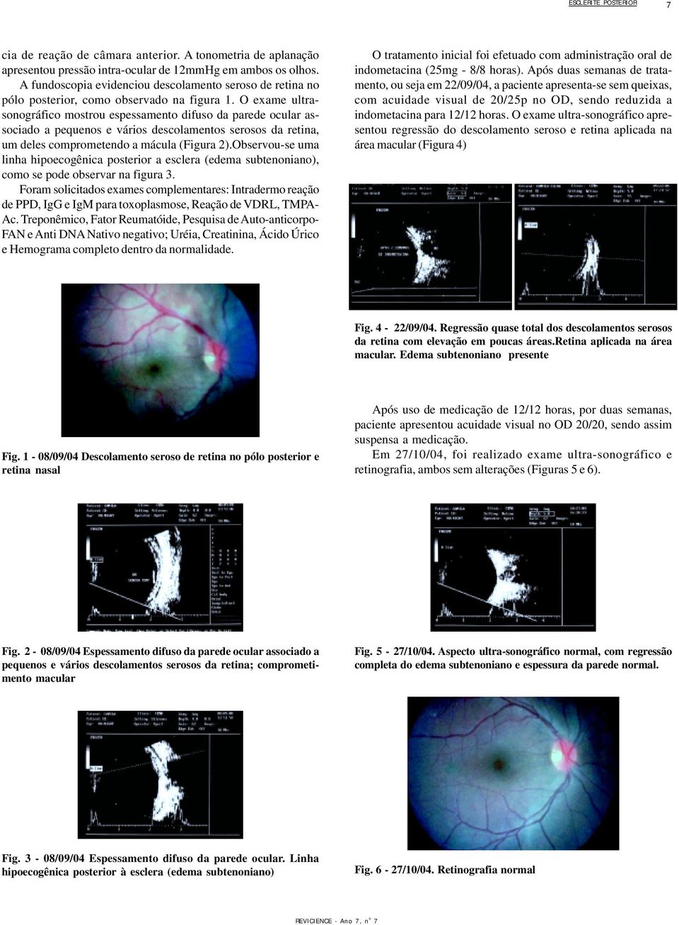 O exame ultrasonográfico mostrou espessamento difuso da parede ocular associado a pequenos e vários descolamentos serosos da retina, um deles comprometendo a mácula (Figura 2).