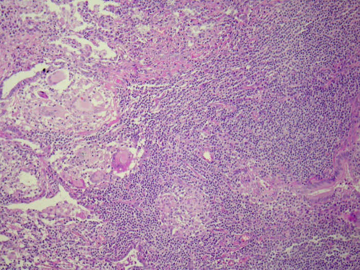 PULMONAR Inflamação intersticial Bronquiolite