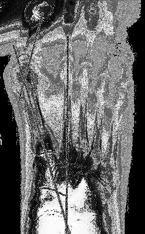 23) O ângulo assinalado na radiografia abaixo é o de a) KITE. b) BÖHLER. c) GISSANE. d) GIANESTRAS. Canale S.T. Campbell s operative orthopaedics. St. Louis: Mosby/Manole. 10a ed.