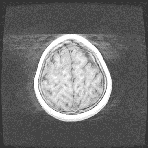 Figura 4 - Imagem T1 de má qualidade, onde houve movimento do paciente. É possível perceber o aparecimento de uma mancha esbranquiçada ao redor do crânio. 2.