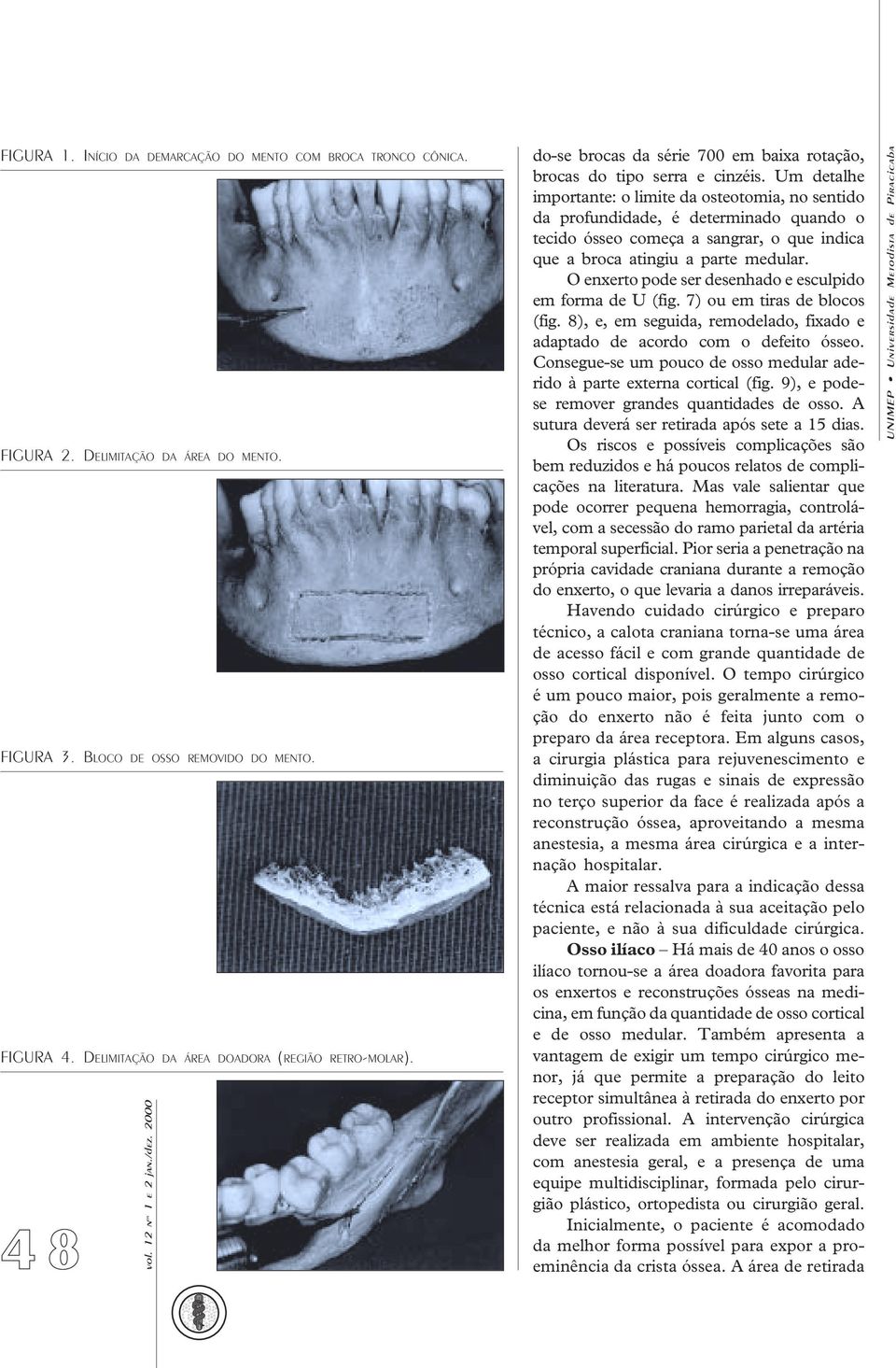 Um detalhe importante: o limite da osteotomia, no sentido da profundidade, é determinado quando o tecido ósseo começa a sangrar, o que indica que a broca atingiu a parte medular.