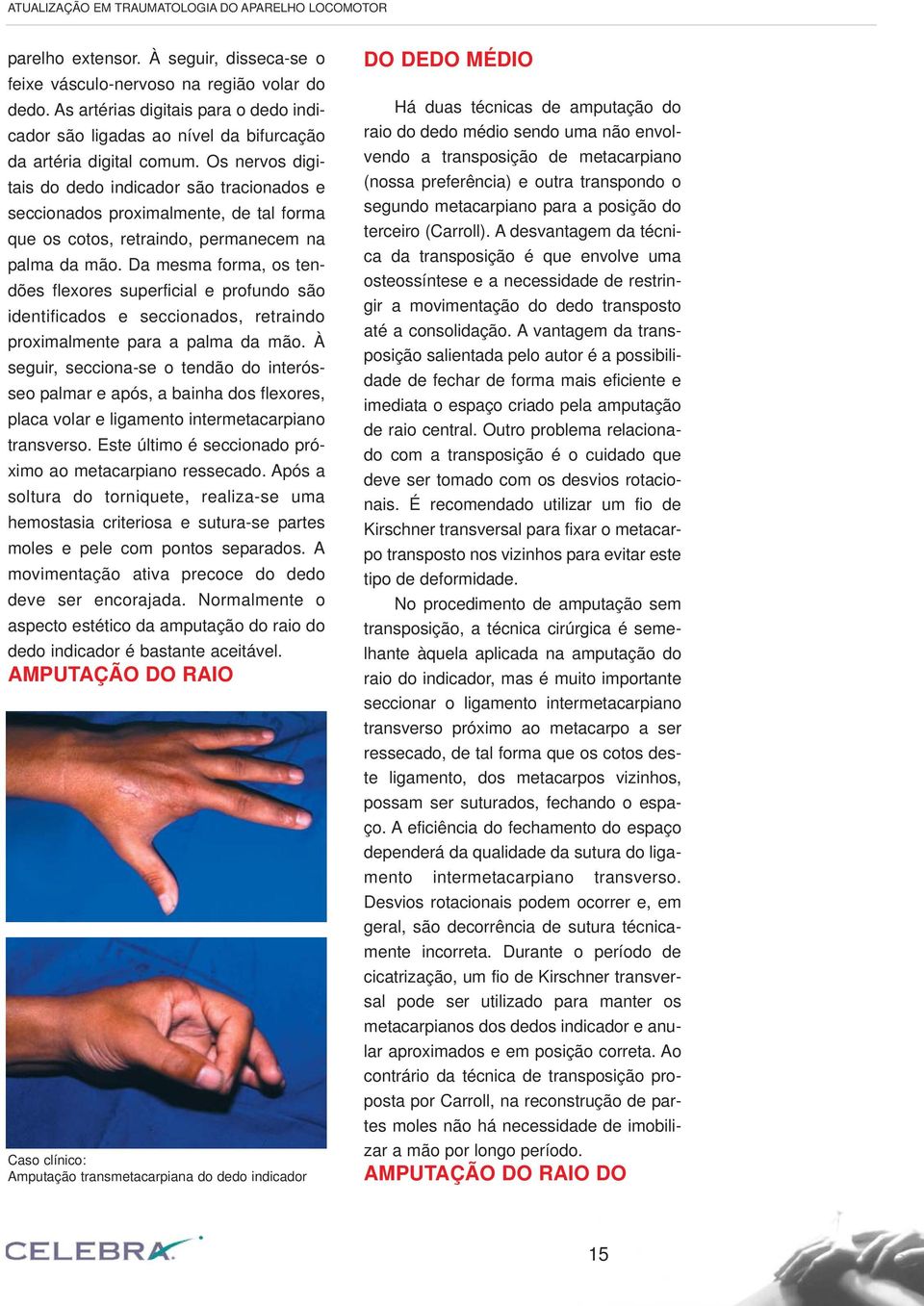 Os nervos digitais do dedo indicador são tracionados e seccionados proximalmente, de tal forma que os cotos, retraindo, permanecem na palma da mão.