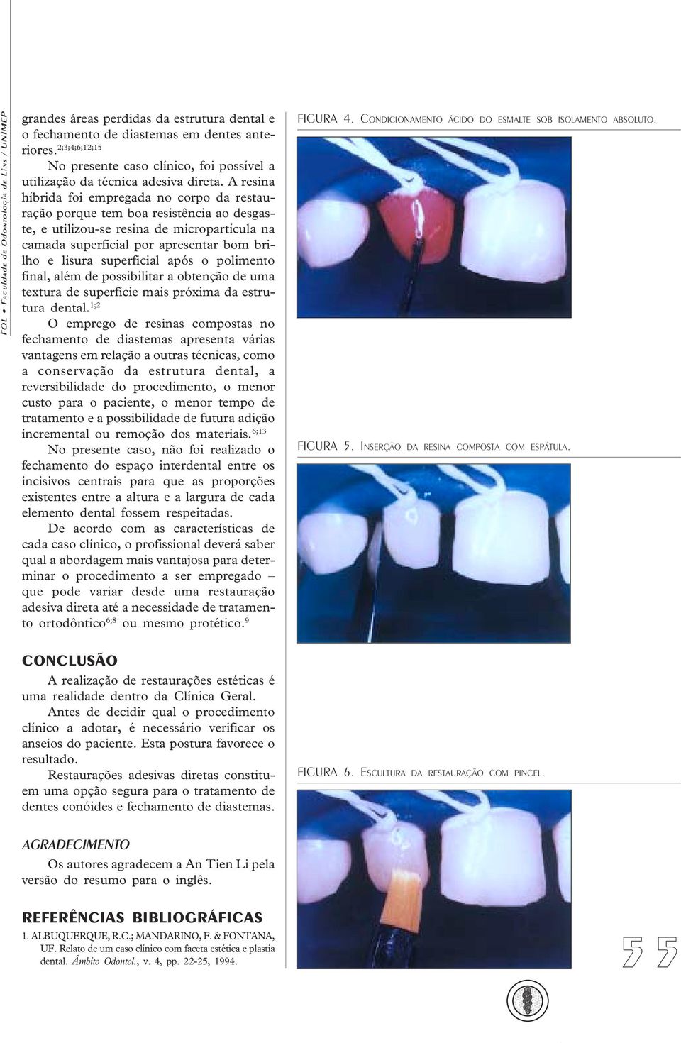 A resina híbrida foi empregada no corpo da restauração porque tem boa resistência ao desgaste, e utilizou-se resina de micropartícula na camada superficial por apresentar bom brilho e lisura