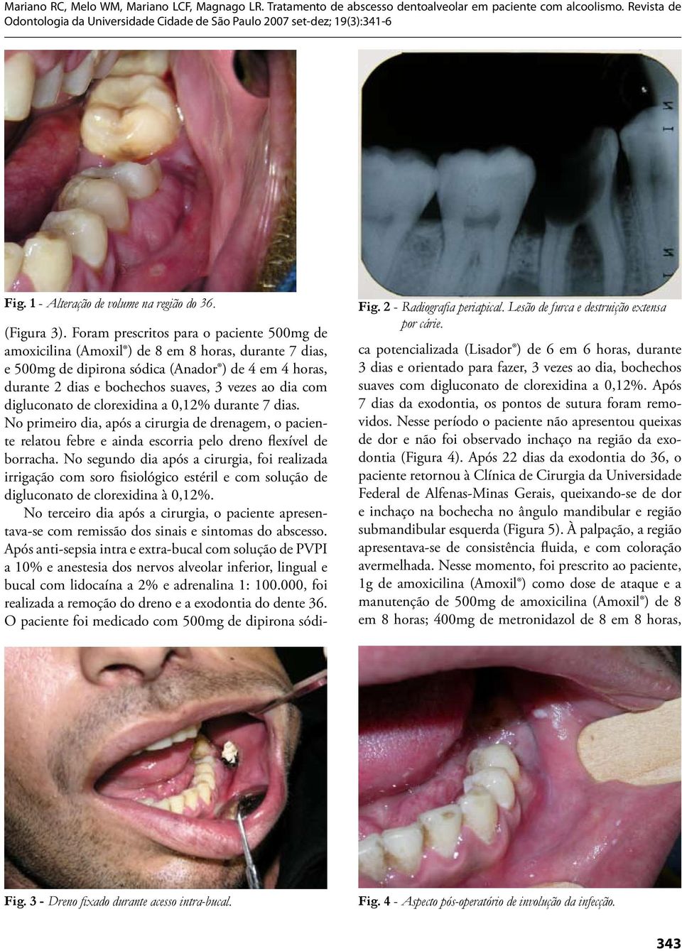 dia com digluconato de clorexidina a 0,12% durante 7 dias. No primeiro dia, após a cirurgia de drenagem, o paciente relatou febre e ainda escorria pelo dreno flexível de borracha.