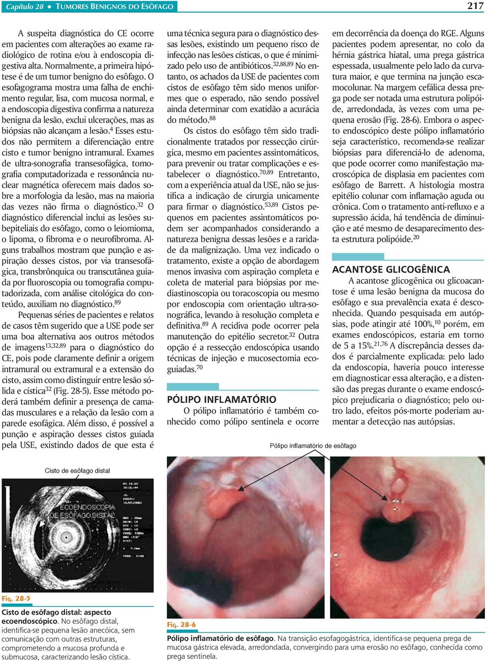 O esofagograma mostra uma falha de enchimento regular, lisa, com mucosa normal, e aendoscopiadigestivaconfirmaanatureza benigna da lesão, exclui ulcerações, mas as biópsias não alcançam a lesão.