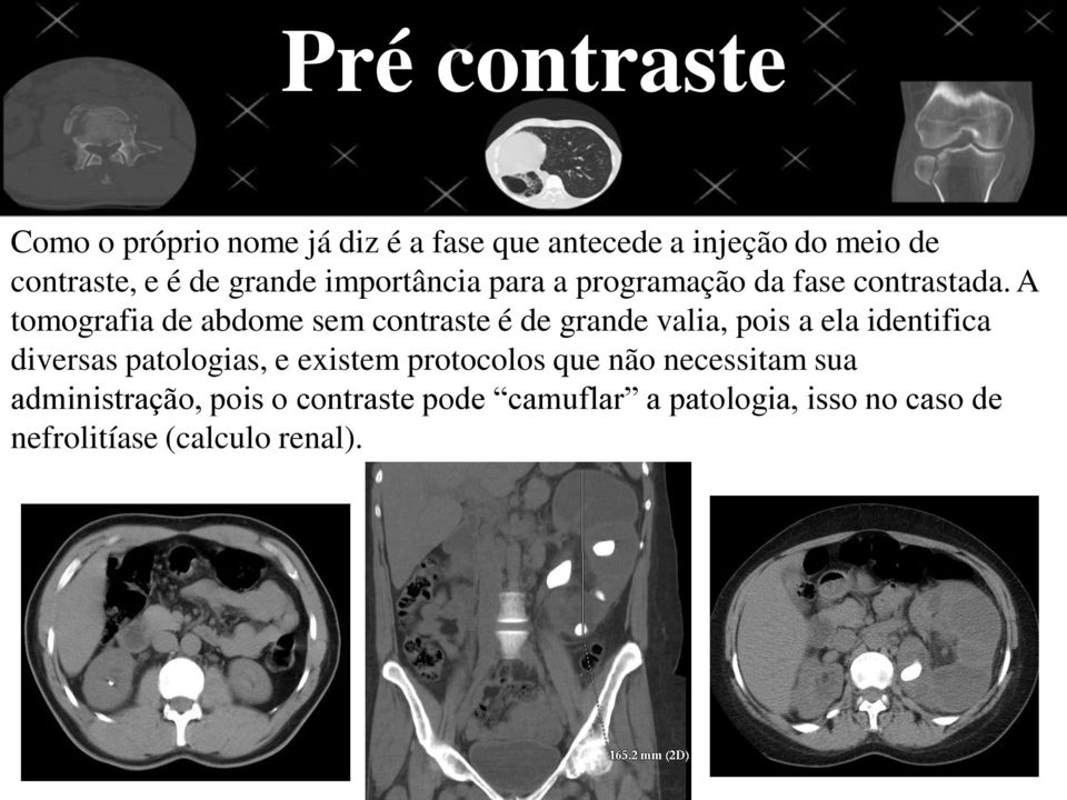 A tomografia de abdome sem contraste é de grande valia, pois a ela identifica diversas patologias, e