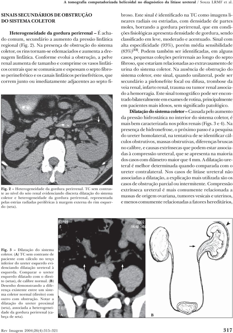 rim esquerdo (seta). Heterogeneidade da gordura perirrenal É achado comum, secundário a aumento da pressão linfática regional (Fig. 2).