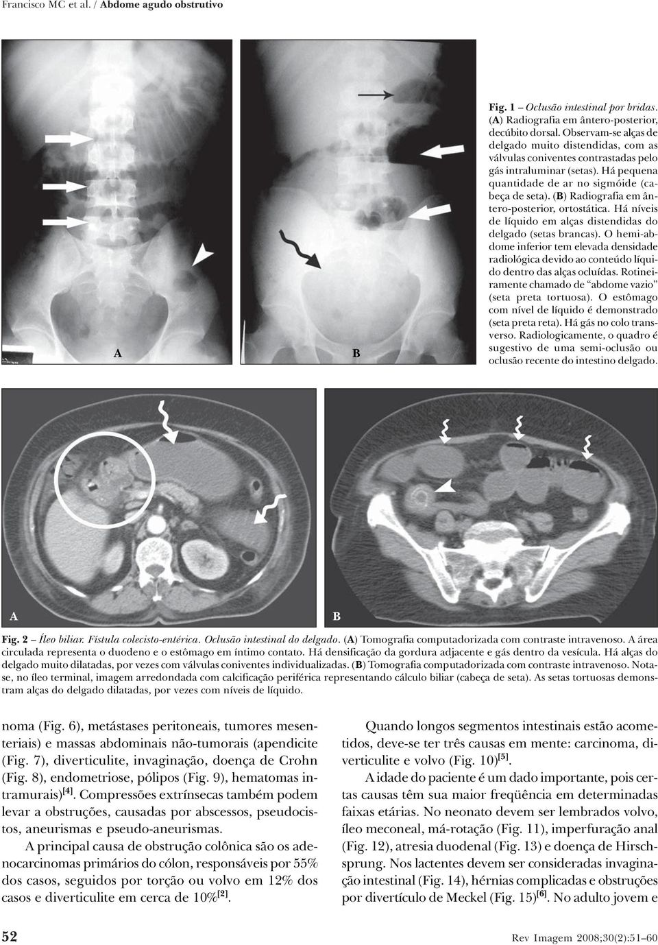 () Radiografia em ântero-posterior, ortostática. Há níveis de líquido em alças distendidas do delgado (setas brancas).