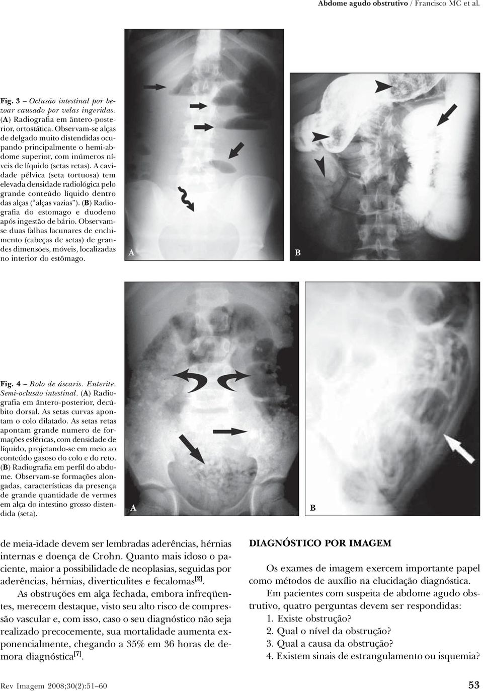 cavidade pélvica (seta tortuosa) tem elevada densidade radiológica pelo grande conteúdo líquido dentro das alças ( alças vazias ). () Radiografia do estomago e duodeno após ingestão de bário.