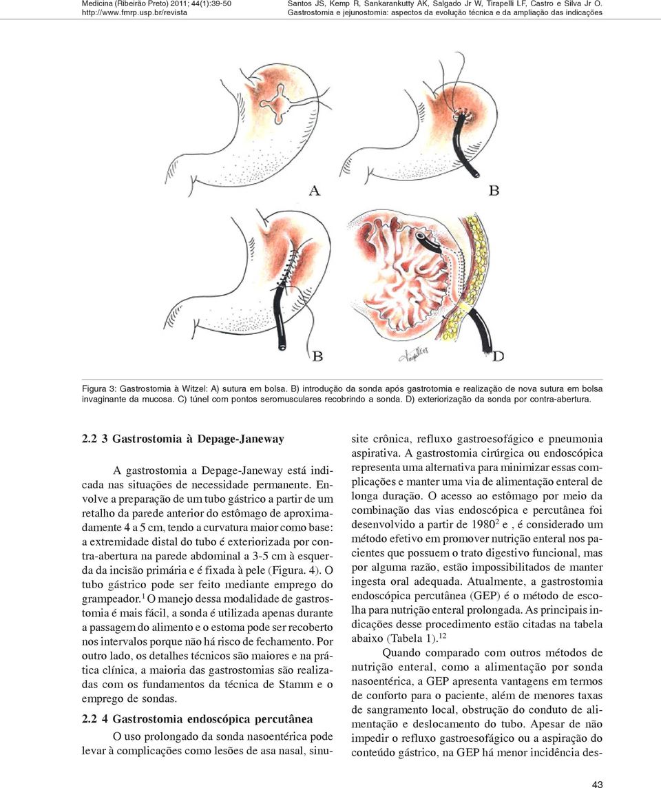 D) exteriorização da sonda por contra-abertura. 2.2 3 Gastrostomia à Depage-Janeway A gastrostomia a Depage-Janeway está indicada nas situações de necessidade permanente.