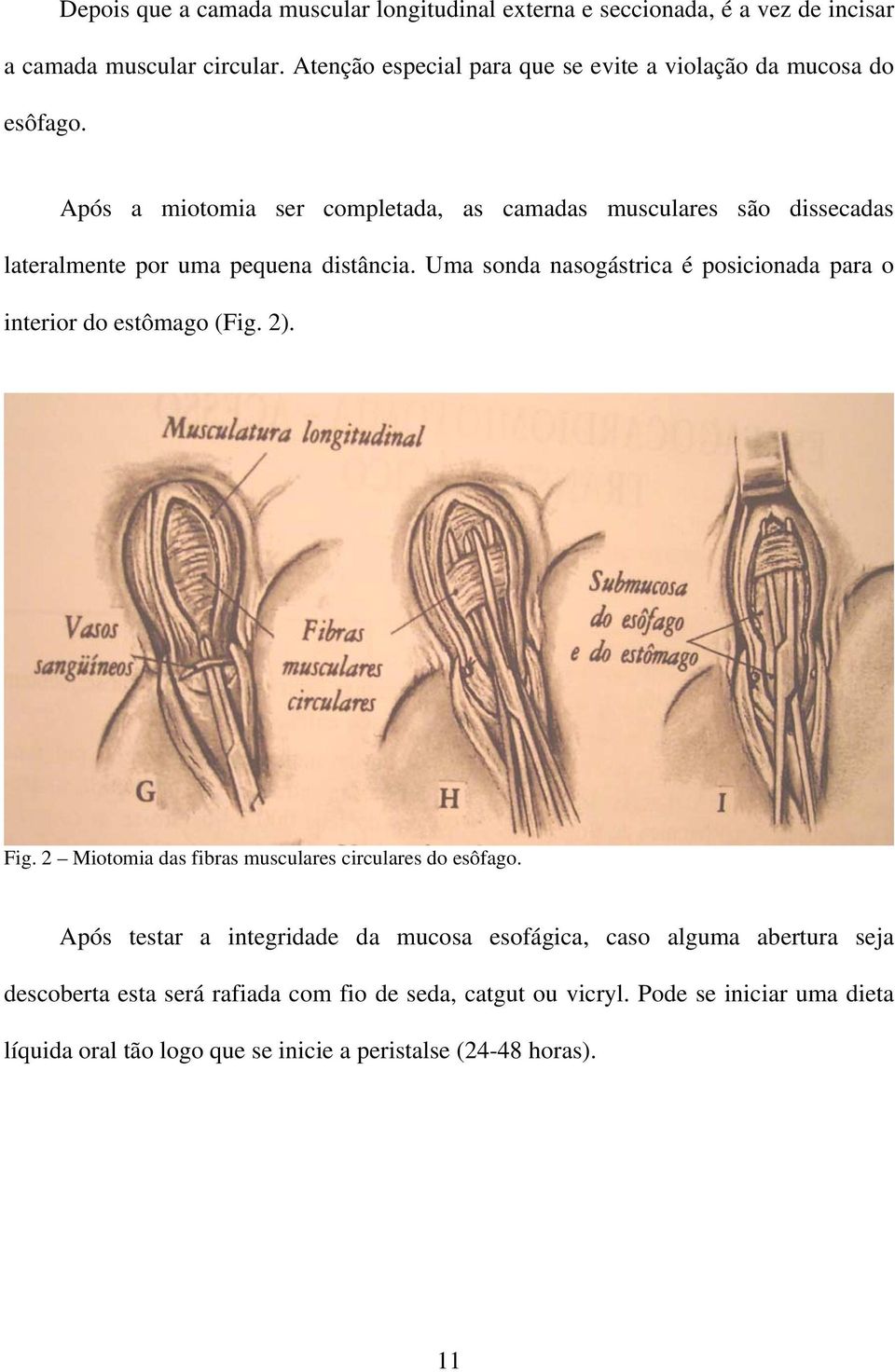 Após a miotomia ser completada, as camadas musculares são dissecadas lateralmente por uma pequena distância.