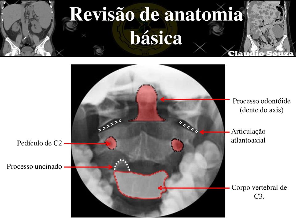 de C2 Articulação atlantoaxial