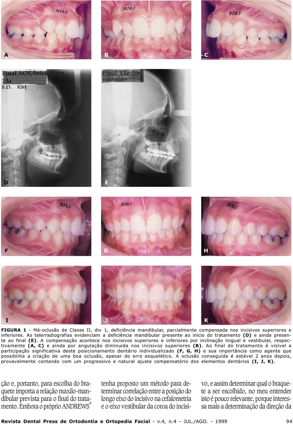 A compensação acontece nos incisivos superiores e inferiores por inclinação lingual e vestibular, respectivamente (A, C) e ainda por angulação diminuida nos incisivos superiores (B).