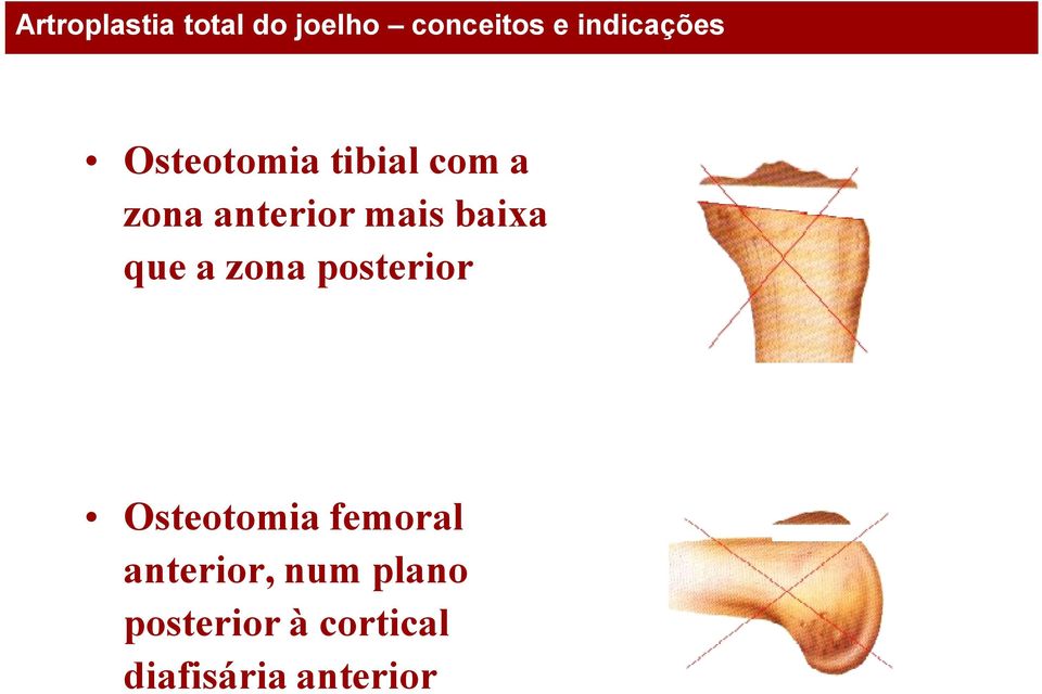 Osteotomia femoral anterior, num