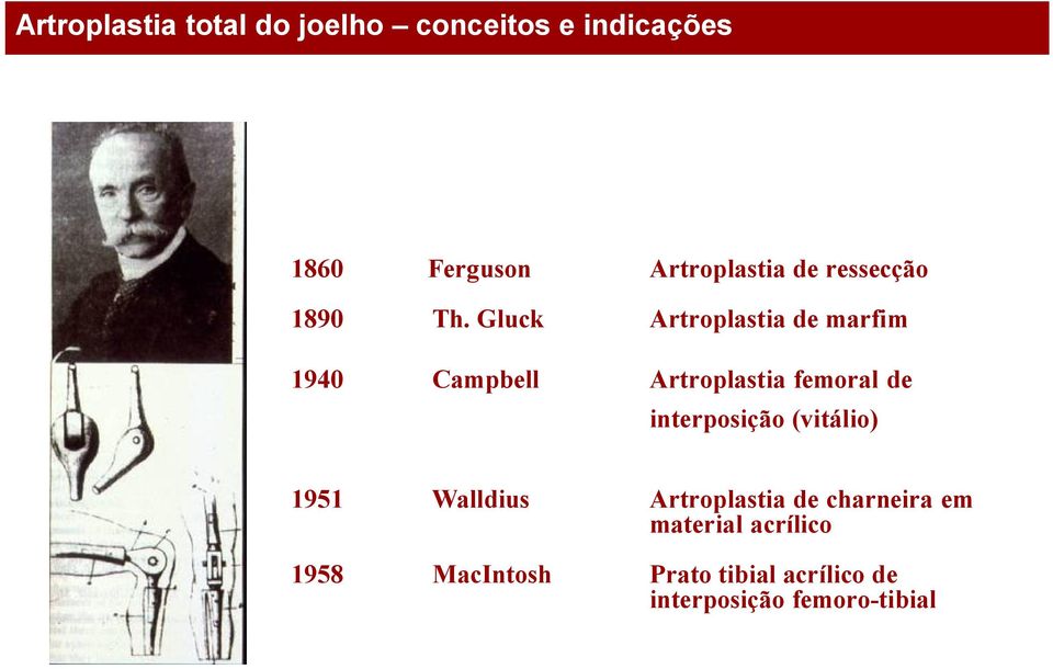 interposição (vitálio) 1951 Walldius Artroplastia de charneira em