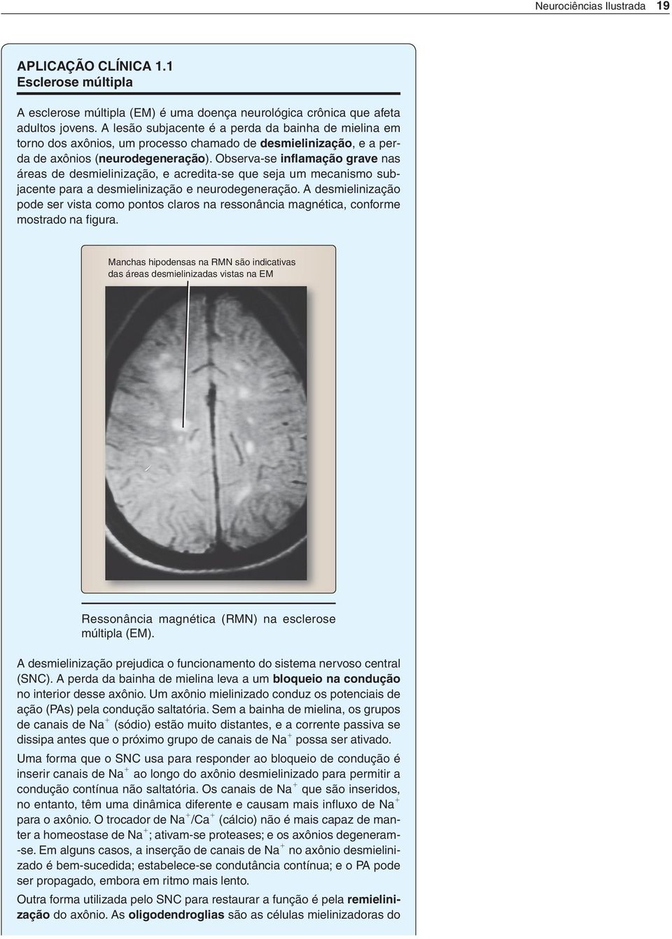 Observase inflamação grave nas áreas de desmielinização, e acreditase que seja um mecanismo subjacente para a desmielinização e neurodegeneração.