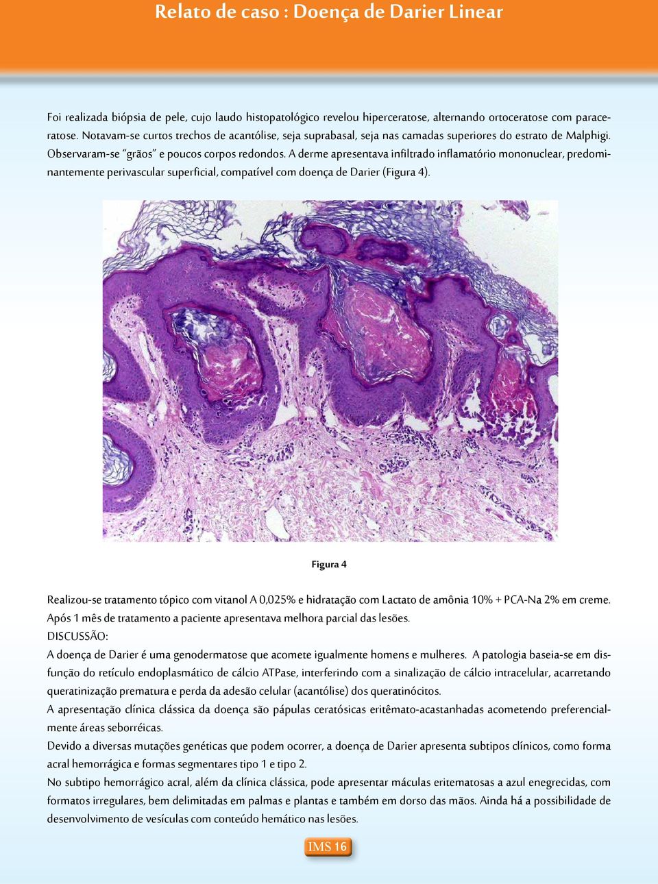 A derme apresentava infiltrado inflamatório mononuclear, predominantemente perivascular superficial, compatível com doença de Darier (Figura 4).