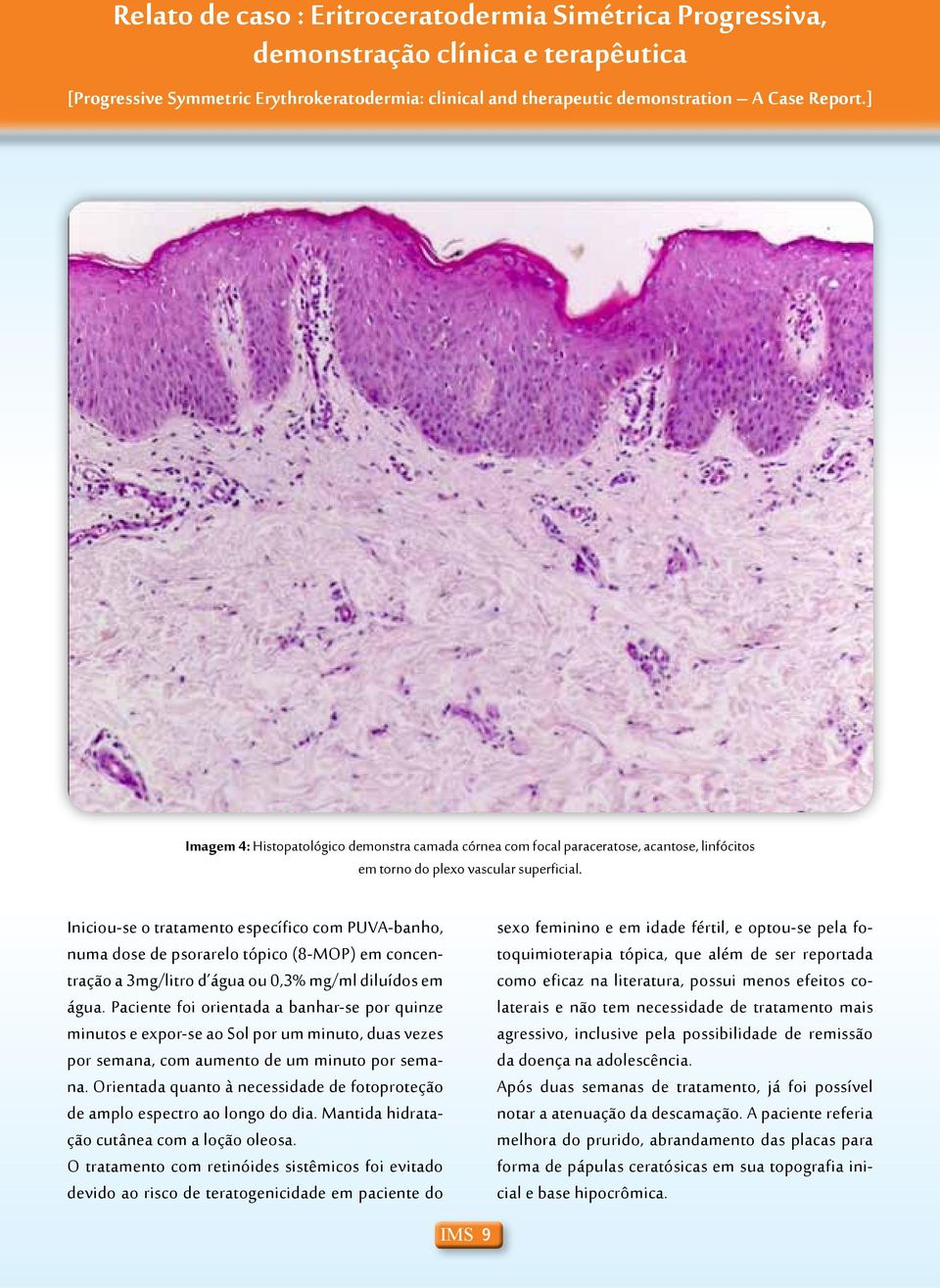 Iniciou-se o tratamento específico com PUVA-banho, numa dose de psorarelo tópico (8-MOP) em concentração a 3mg/litro d água ou 0,3% mg/ml diluídos em água.