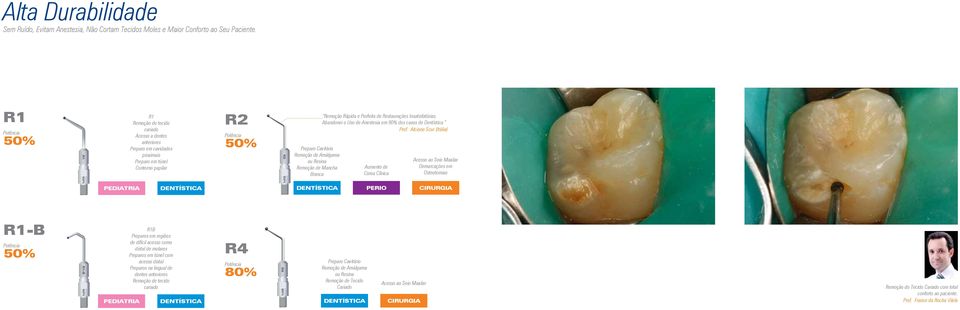 Mancha Branca Remoção Rápida e Perfeita de Restaurações Insatisfatórias. Abandonei o Uso de Anestesia em 90% dos casos de Dentística. Prof.